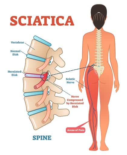 Sciatica and Leg Pain Treatment